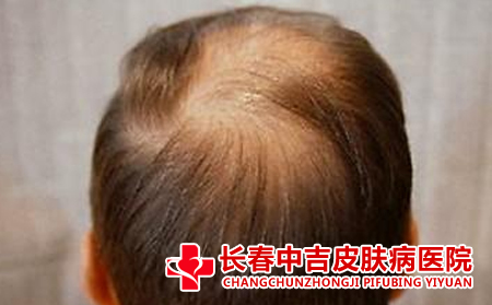 如何正确看待脱发