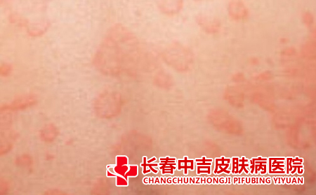 如何对荨麻疹进行止痒