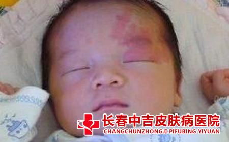  预防胎记的方法有哪些