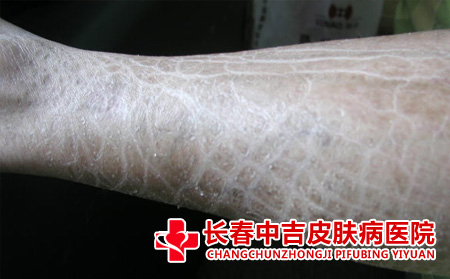 鱼鳞病有哪些特点