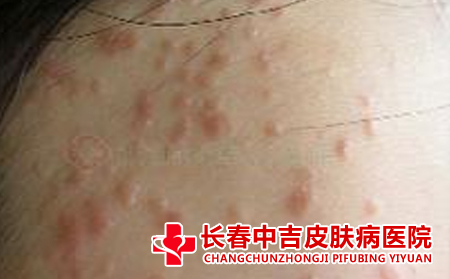 如何去除扁平疣
