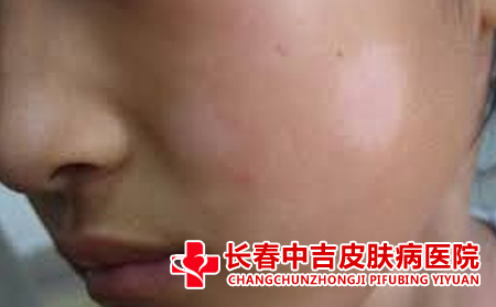 白癜风与白斑之间的区别