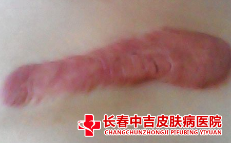 治疗瘢痕的费用