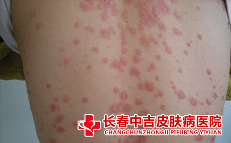 红斑狼疮的分类是什么