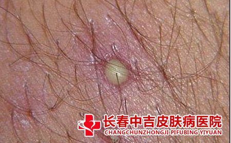  毛囊炎的预防措施