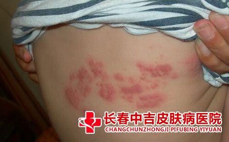 湿疹的诱发因素有哪些