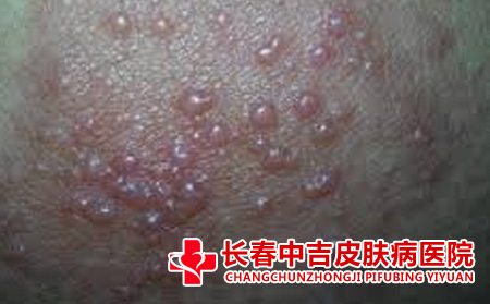导致湿疹不良后果的因素