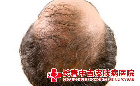  如何正确看待脱发问题
