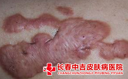 生理性和病理性瘢痕的不同之处