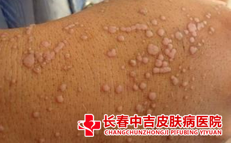 如何治疗扁平庞