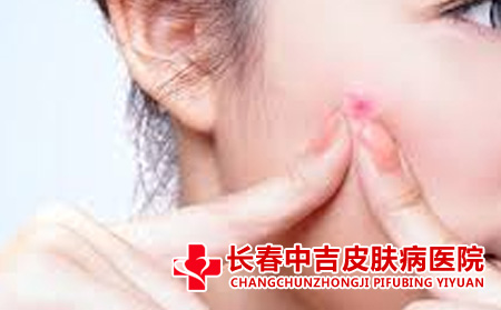 手挤痤疮的不良后果