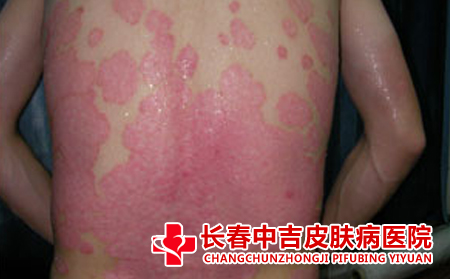 如何正确看待红斑狼疮的传染问题