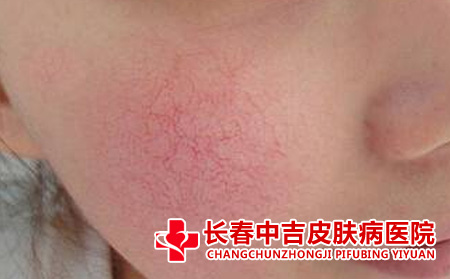 如何预防红血丝的出现