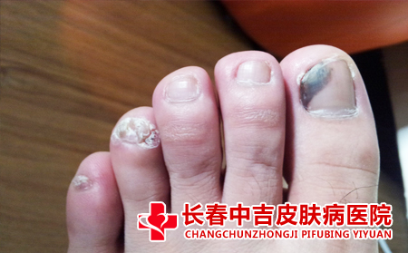  灰指甲与穿鞋有关吗