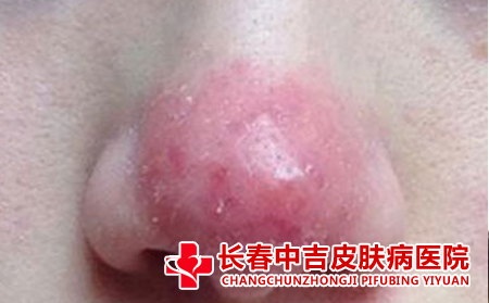 酒槽鼻初期有哪些特征