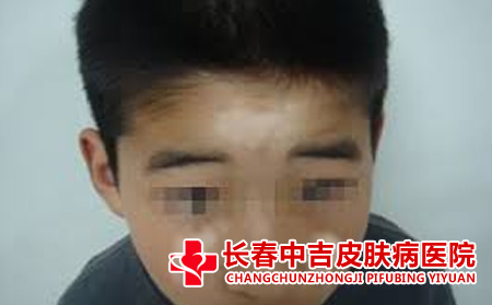 白斑的表现症状