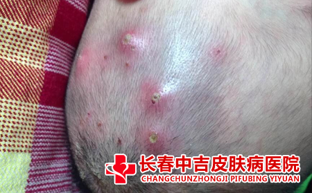 导致毛囊炎产生的原因