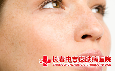 雀斑与遗传的关系是什么