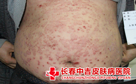体癣如何正确表现
