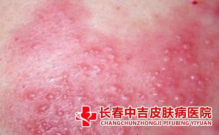 湿疹有哪些特点