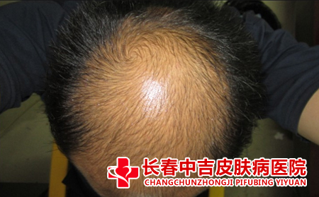 如何正确对待脱发