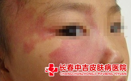 如何对胎记进行分类