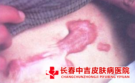 瘢痕的应对措施