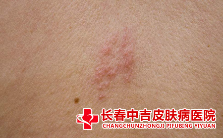 疱疹病症