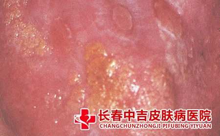 疱疹病症表现