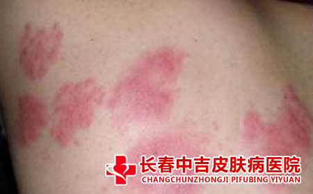 红斑狼疮的病症