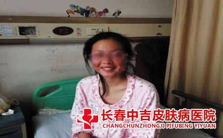 红斑狼疮接受治疗