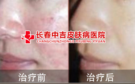 红斑狼疮治疗后看到了效果
