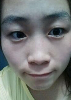 在长春中吉接受治疗后黄褐斑恢复