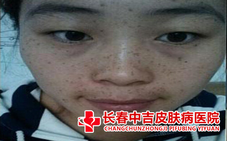 严重的黄褐斑病症