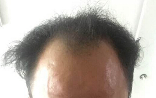 严重的脱发问题