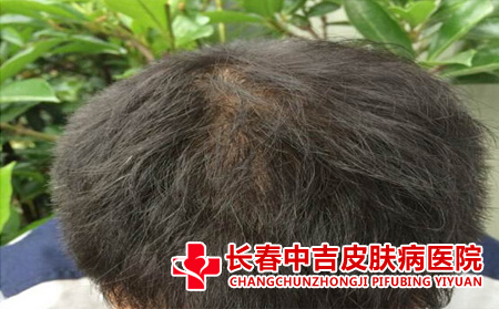 脱发的症状有了合适转