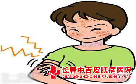 鱼鳞病切忌挠痒