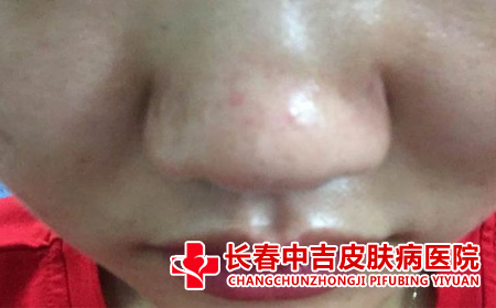 酒槽鼻症状判断