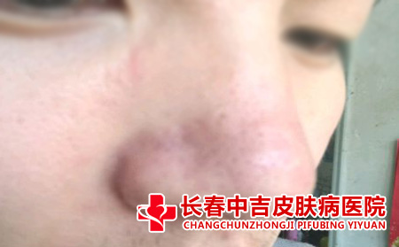 食物刺激导致的酒槽鼻