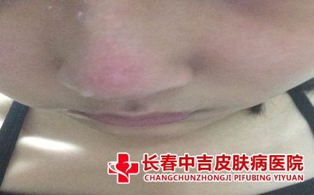 丘疹期酒糟鼻