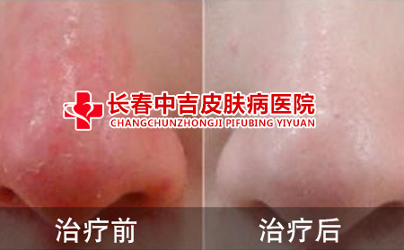 酒槽鼻治疗前后对比