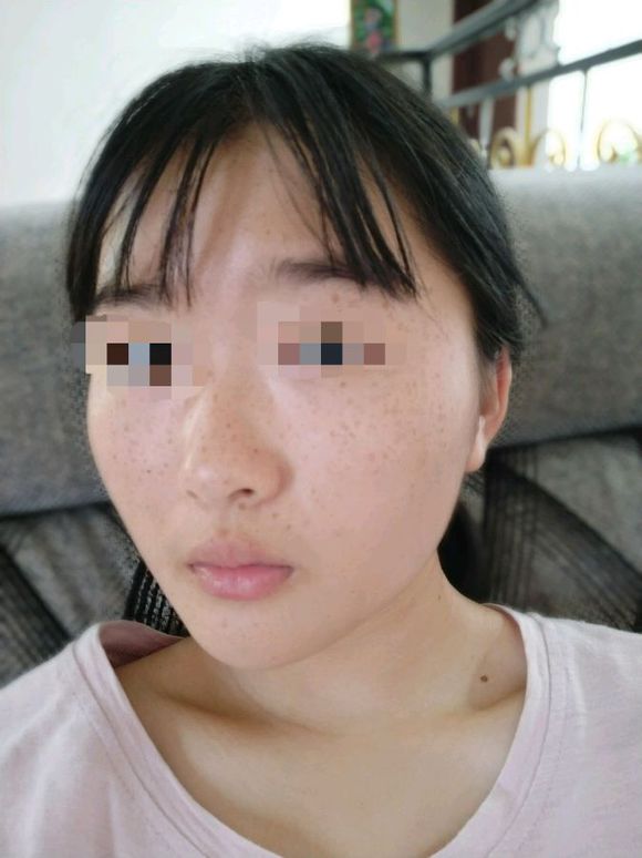 密密麻麻的雀斑