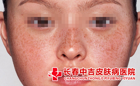 雀斑症状
