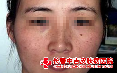 错误的治疗导致雀斑进一步加重