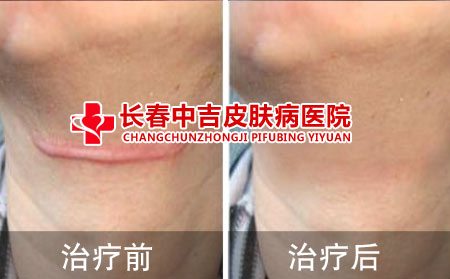 瘢痕治疗前后对比