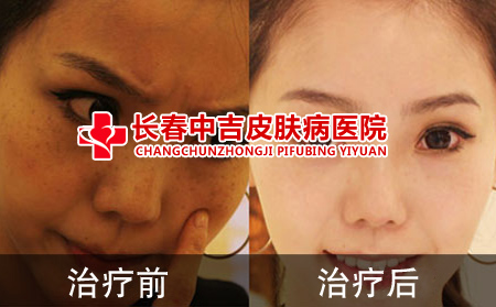 激光祛斑前后对比