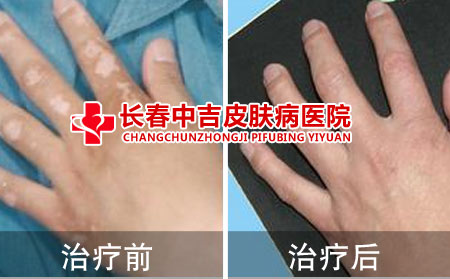 白癜风治疗前后