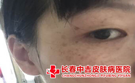 雀斑症状