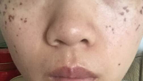为雀斑而郁闷
