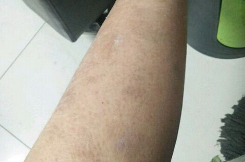 鱼鳞病特征